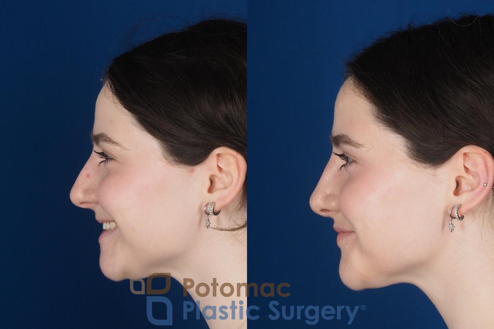 Before & After Rhinoplasty - Cosmetic Case 345 Left - Smiling View in Washington DC & Arlington , DC