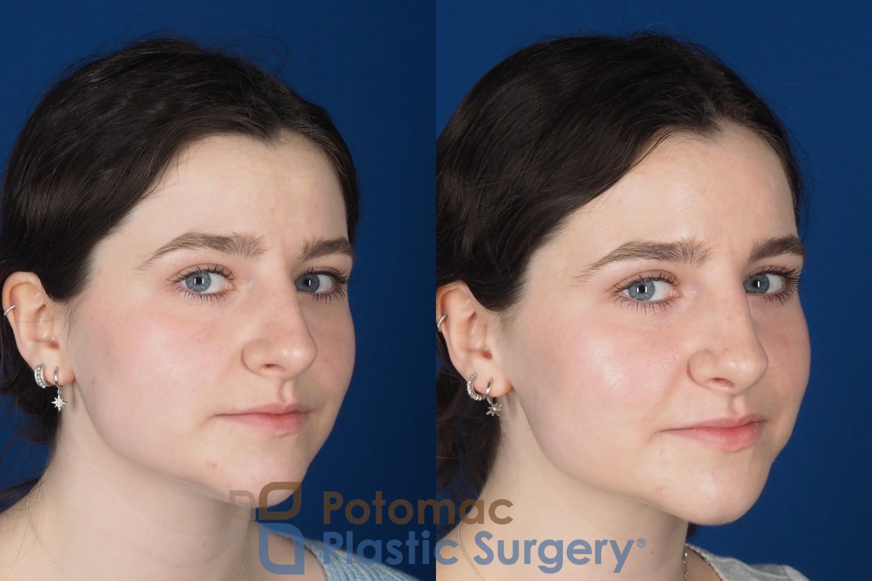Before & After Rhinoplasty - Cosmetic Case 345 Right Oblique 2 View in Washington DC & Arlington , DC