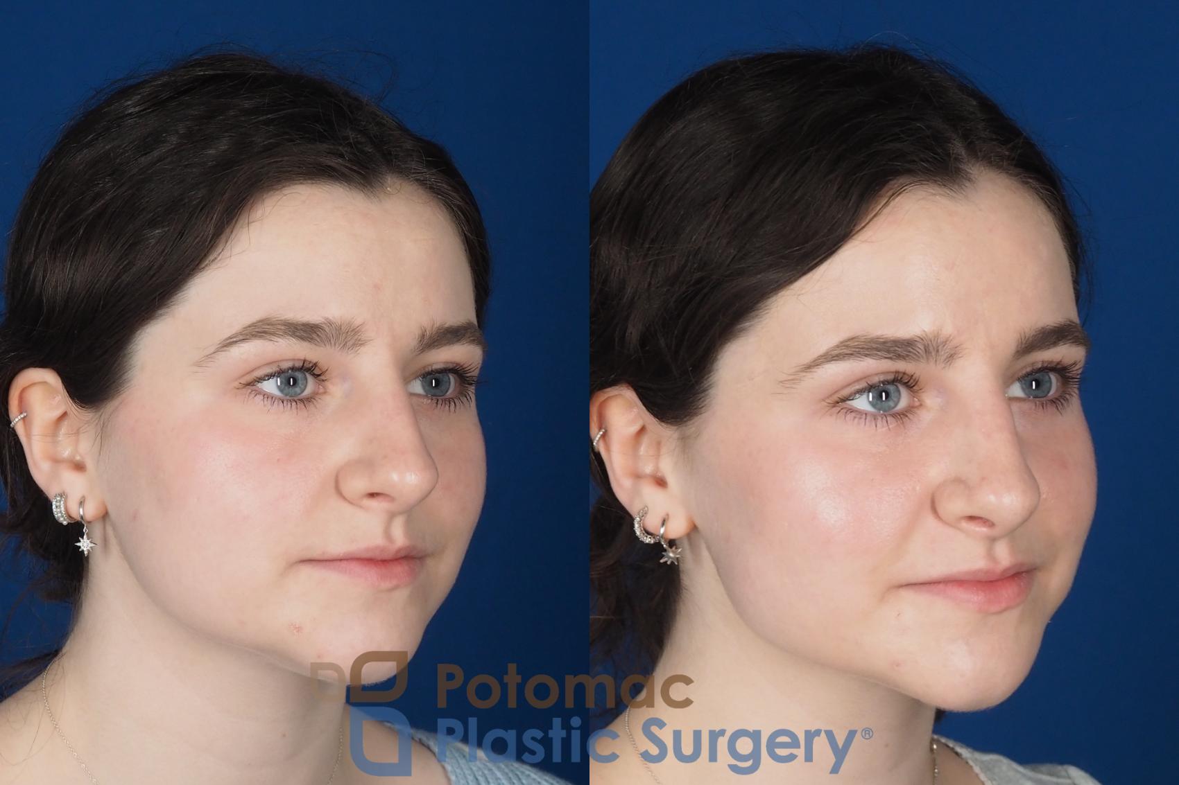 Before & After Rhinoplasty - Cosmetic Case 345 Right Oblique View in Washington DC & Arlington , DC