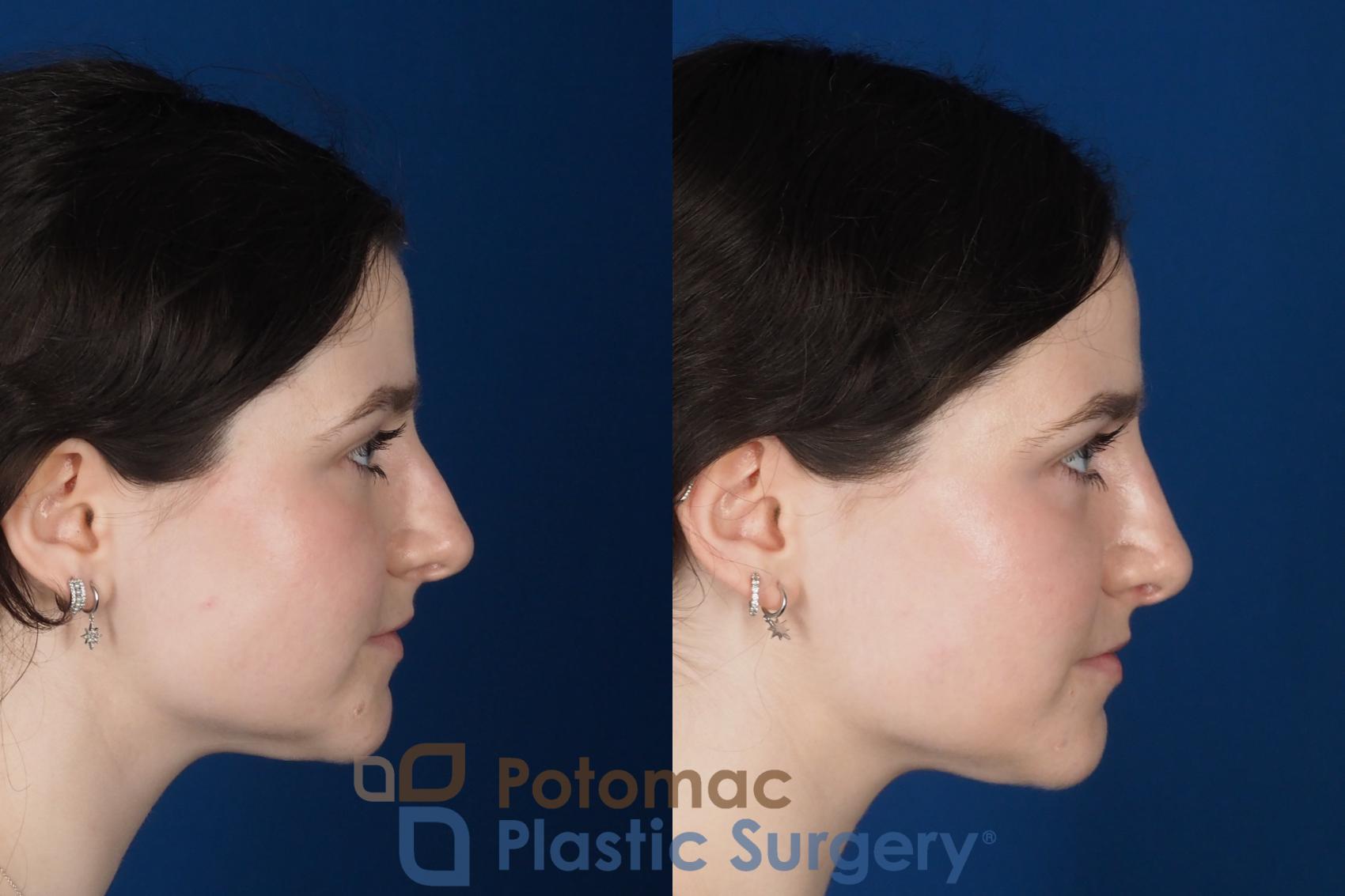 Before & After Rhinoplasty - Cosmetic Case 345 Right Side View in Washington DC & Arlington , DC