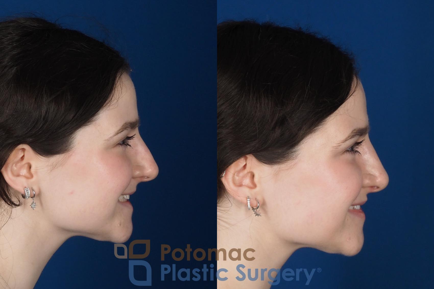Before & After Rhinoplasty - Cosmetic Case 345 Right - Smiling View in Washington DC & Arlington , DC
