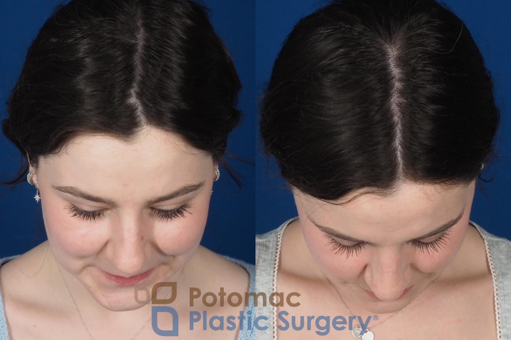 Before & After Rhinoplasty - Cosmetic Case 345 Top View in Washington DC & Arlington , DC