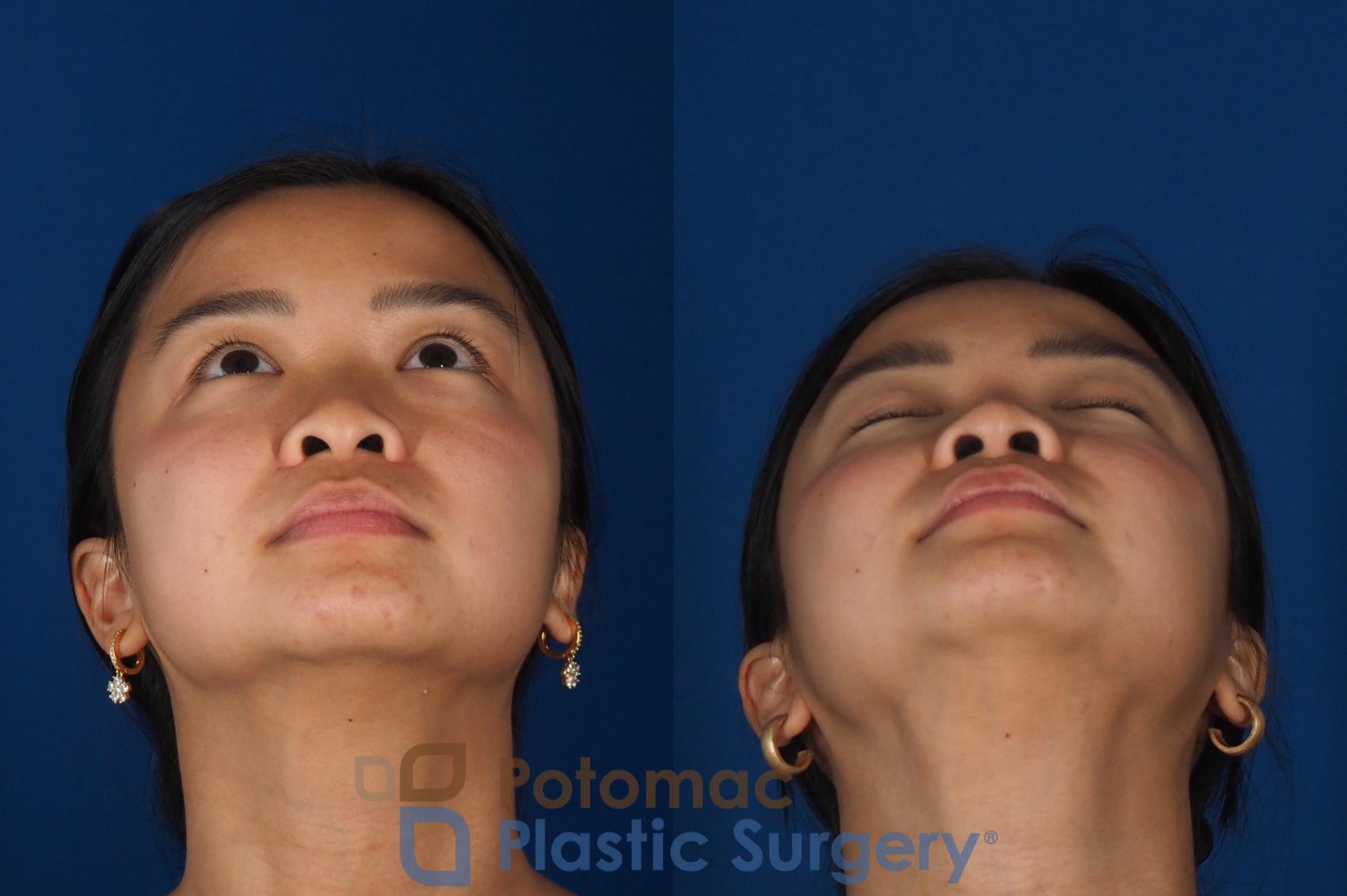 Before & After Rhinoplasty - Cosmetic Case 349 Bottom View in Washington DC & Arlington , DC