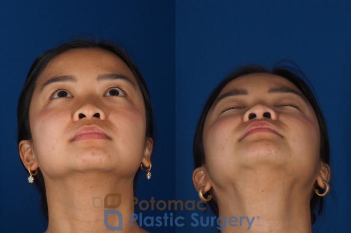 Before & After Rhinoplasty - Cosmetic Case 349 Bottom View in Washington DC & Arlington , DC