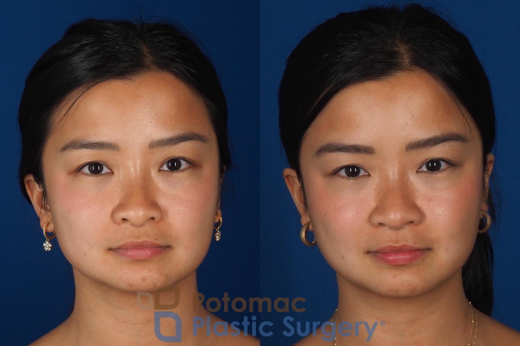 Before & After Rhinoplasty - Cosmetic Case 349 Front View in Washington DC & Arlington , DC