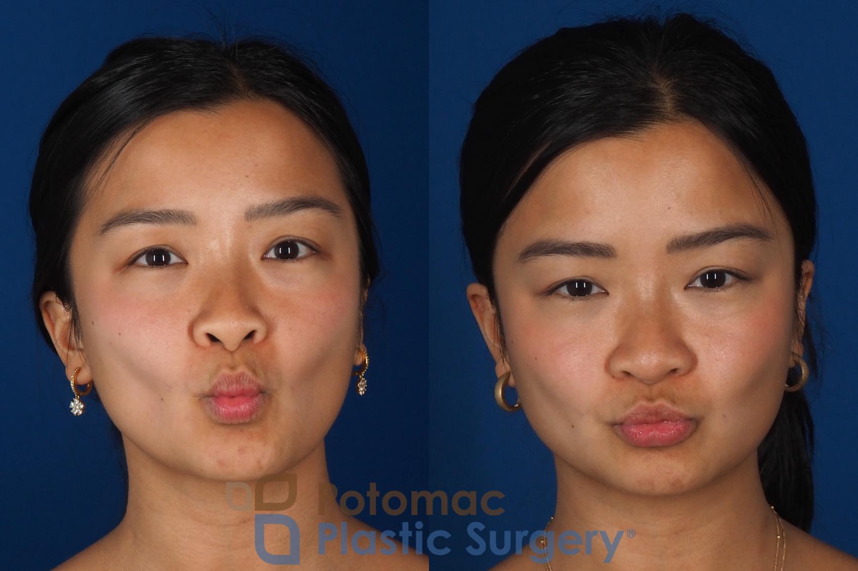 Before & After Rhinoplasty - Cosmetic Case 349 Front - Puckering View in Washington DC & Arlington , DC
