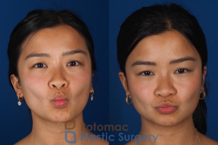 Before & After Rhinoplasty - Cosmetic Case 349 Front - Puckering View in Washington DC & Arlington , DC