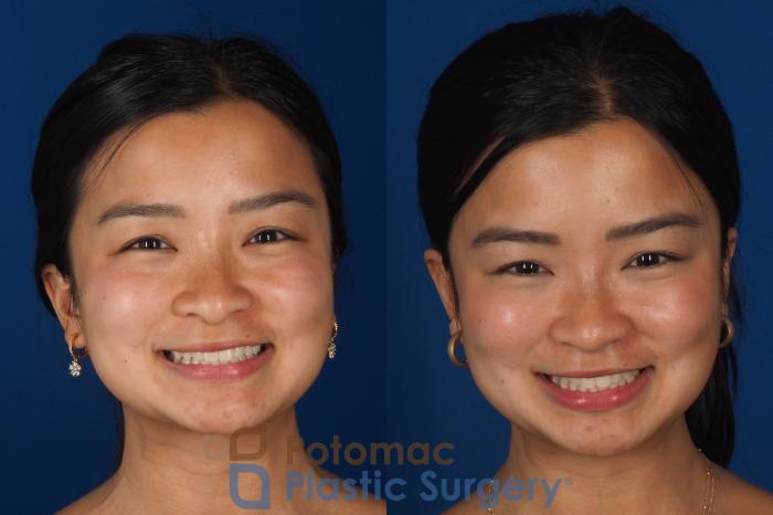 Before & After Rhinoplasty - Cosmetic Case 349 Front - Smiling View in Washington DC & Arlington , DC