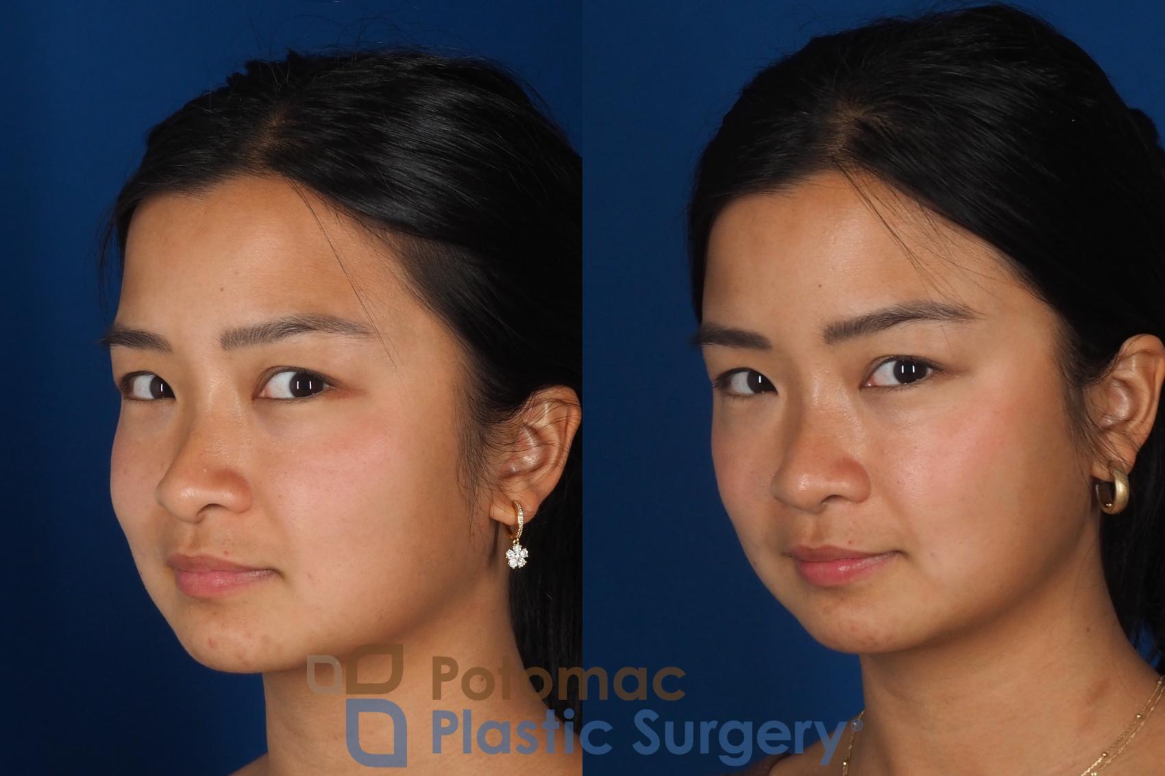 Before & After Rhinoplasty - Cosmetic Case 349 Left Oblique 2 View in Washington DC & Arlington , DC
