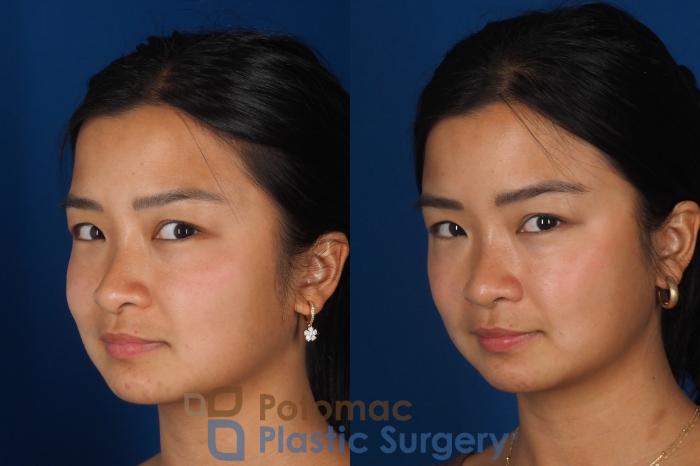 Before & After Rhinoplasty - Cosmetic Case 349 Left Oblique 2 View in Washington DC & Arlington , DC