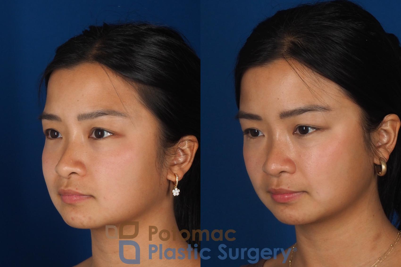 Before & After Rhinoplasty - Cosmetic Case 349 Left Oblique View in Washington DC & Arlington , DC