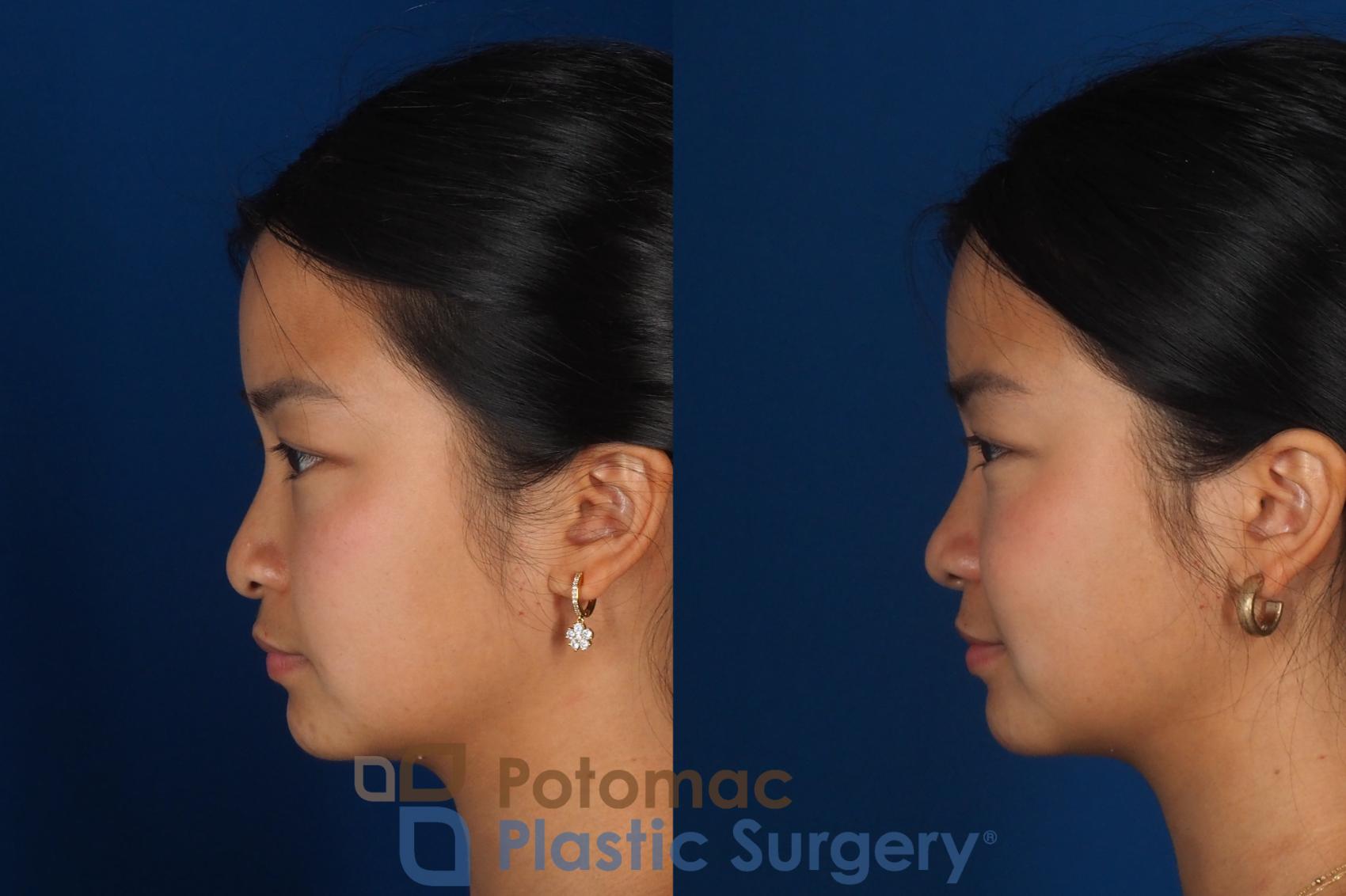 Before & After Rhinoplasty - Cosmetic Case 349 Left Side View in Washington DC & Arlington , DC