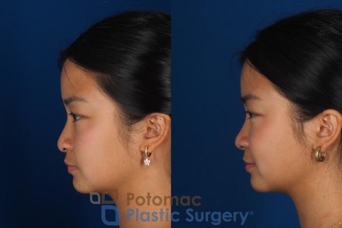 Before & After Rhinoplasty - Cosmetic Case 349 Left Side View in Washington DC & Arlington , DC
