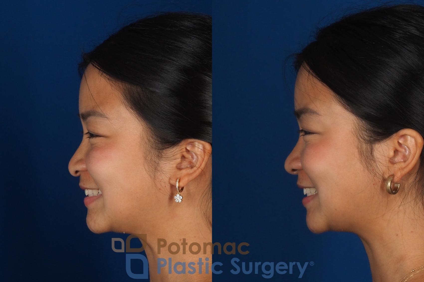 Before & After Rhinoplasty - Cosmetic Case 349 Left - Smiling View in Washington DC & Arlington , DC