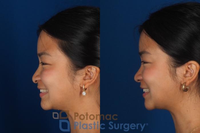Before & After Rhinoplasty - Cosmetic Case 349 Left - Smiling View in Washington DC & Arlington , DC