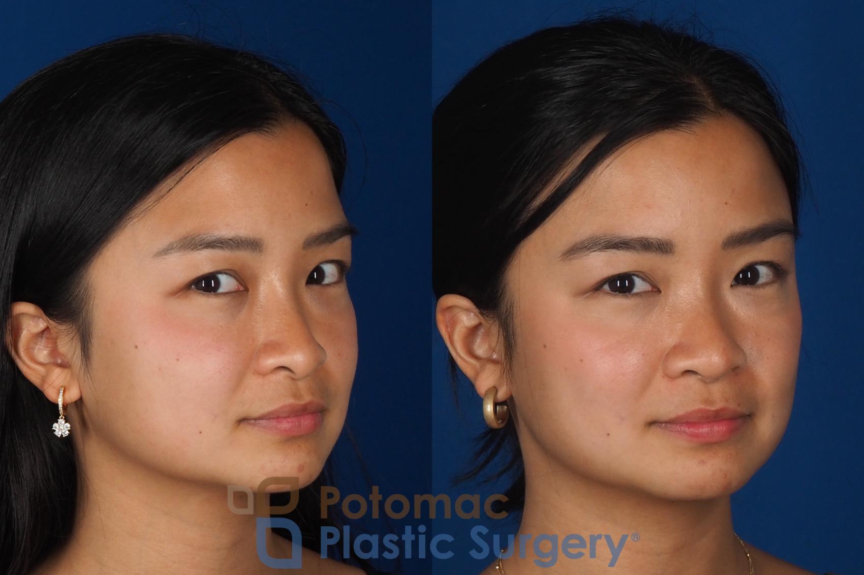 Before & After Rhinoplasty - Cosmetic Case 349 Right Oblique 2 View in Washington DC & Arlington , DC