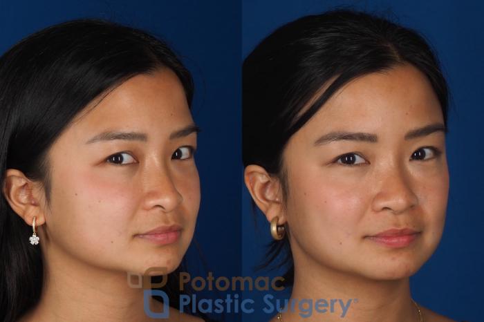 Before & After Rhinoplasty - Cosmetic Case 349 Right Oblique 2 View in Washington DC & Arlington , DC