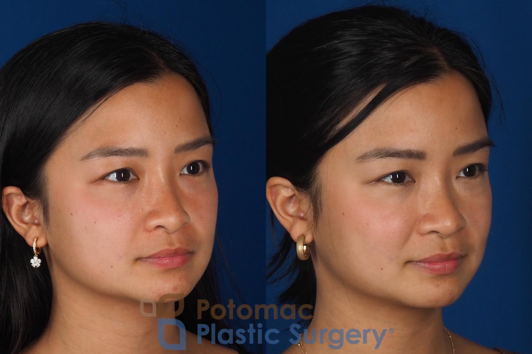 Before & After Rhinoplasty - Cosmetic Case 349 Right Oblique View in Washington DC & Arlington , DC