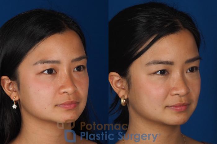 Before & After Rhinoplasty - Cosmetic Case 349 Right Oblique View in Washington DC & Arlington , DC