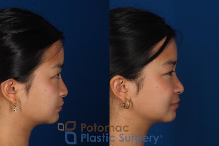 Before & After Rhinoplasty - Cosmetic Case 349 Right Side View in Washington DC & Arlington , DC