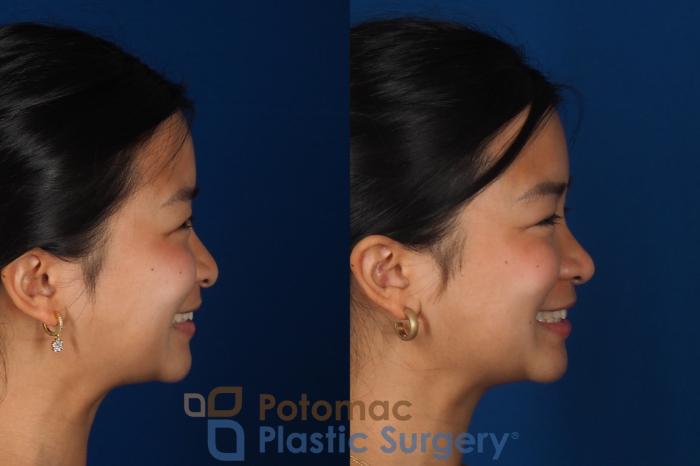 Before & After Rhinoplasty - Cosmetic Case 349 Right - Smiling View in Washington DC & Arlington , DC
