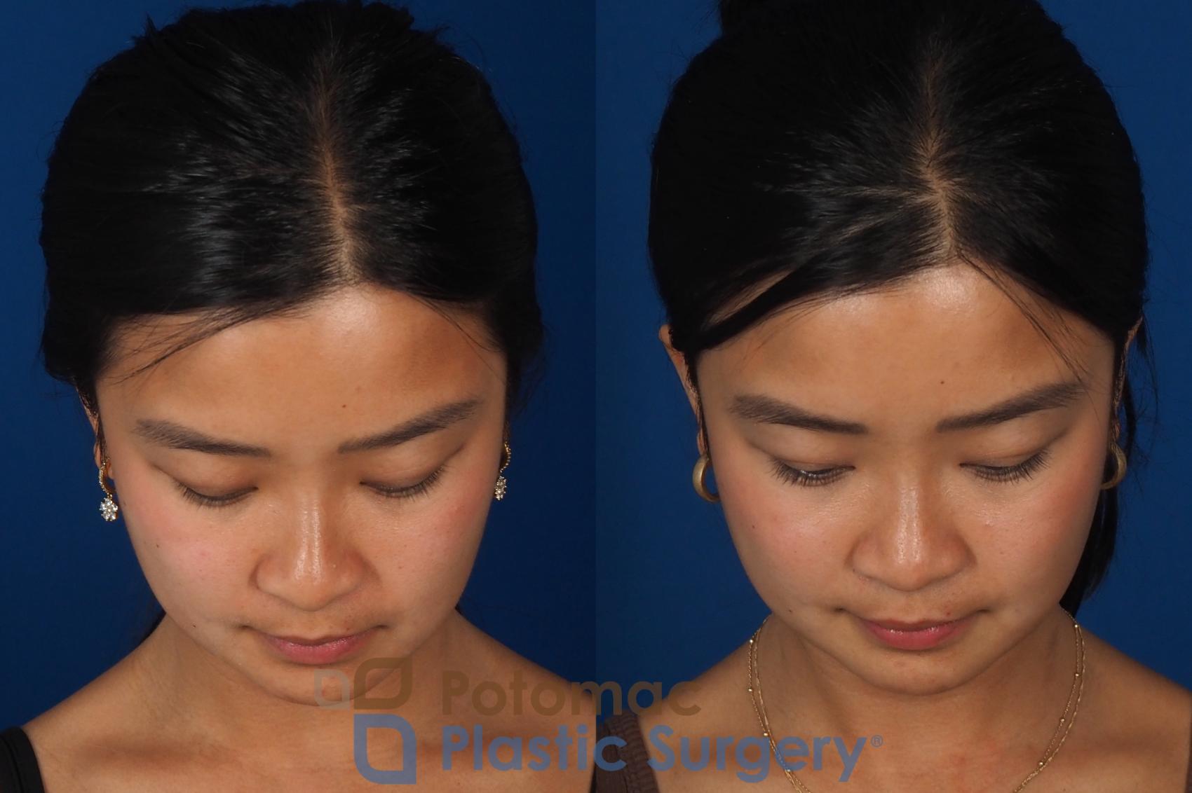 Before & After Rhinoplasty - Cosmetic Case 349 Top View in Washington DC & Arlington , DC
