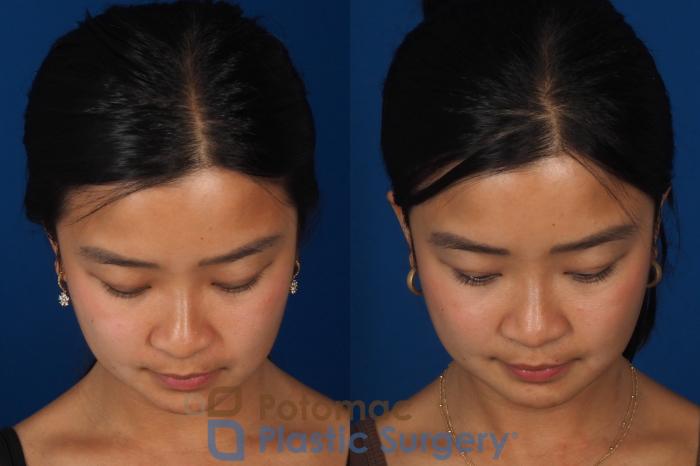 Before & After Rhinoplasty - Cosmetic Case 349 Top View in Washington DC & Arlington , DC