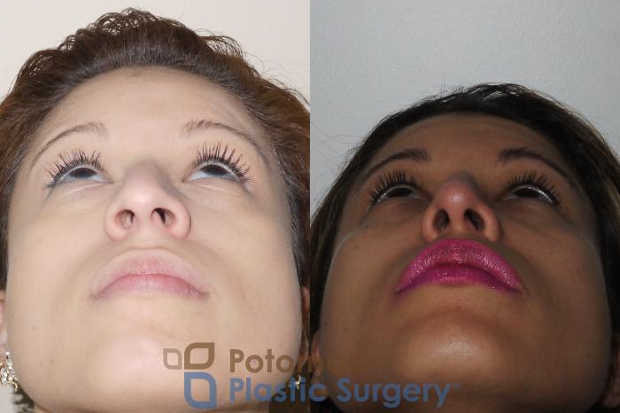Before & After Rhinoplasty - Cosmetic Case 351 Bottom View in Washington DC & Arlington , DC