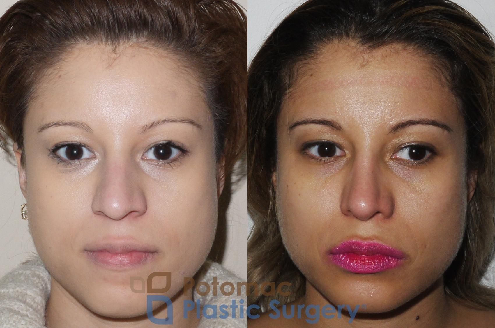 Before & After Rhinoplasty - Cosmetic Case 351 Front View in Washington DC & Arlington , DC