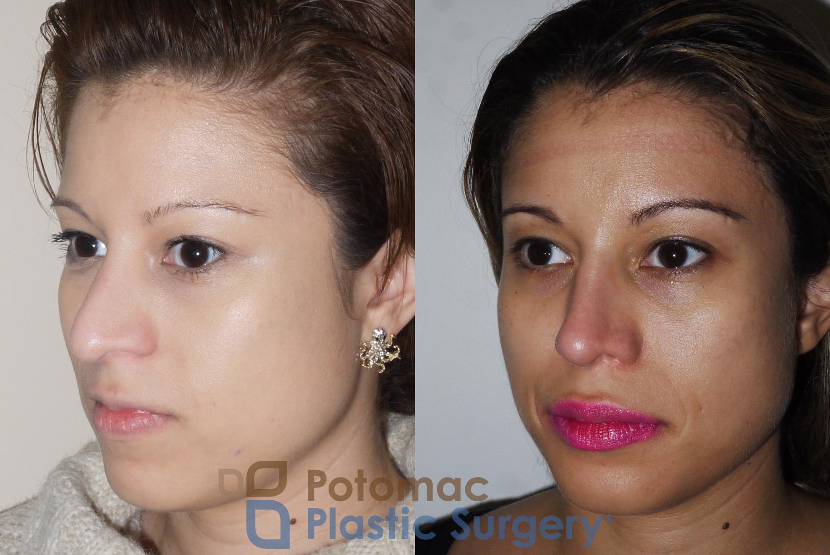 Before & After Rhinoplasty - Cosmetic Case 351 Left Oblique View in Washington DC & Arlington , DC