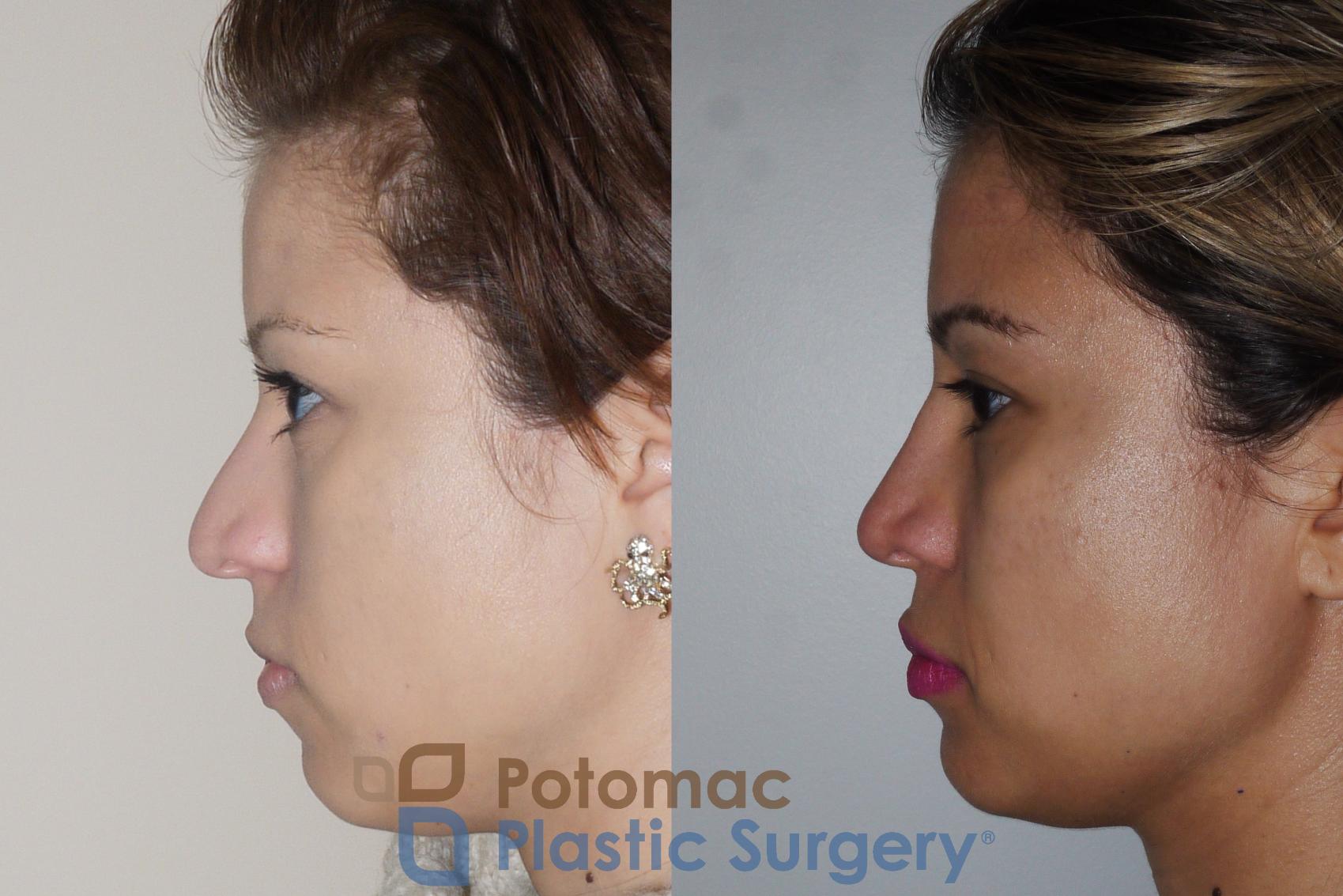 Before & After Rhinoplasty - Cosmetic Case 351 Left Side View in Washington DC & Arlington , DC