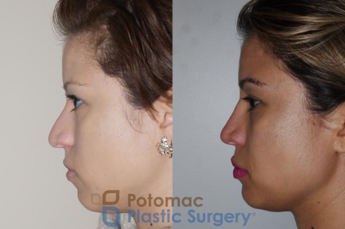Before & After Rhinoplasty - Cosmetic Case 351 Left Side View in Washington DC & Arlington , DC