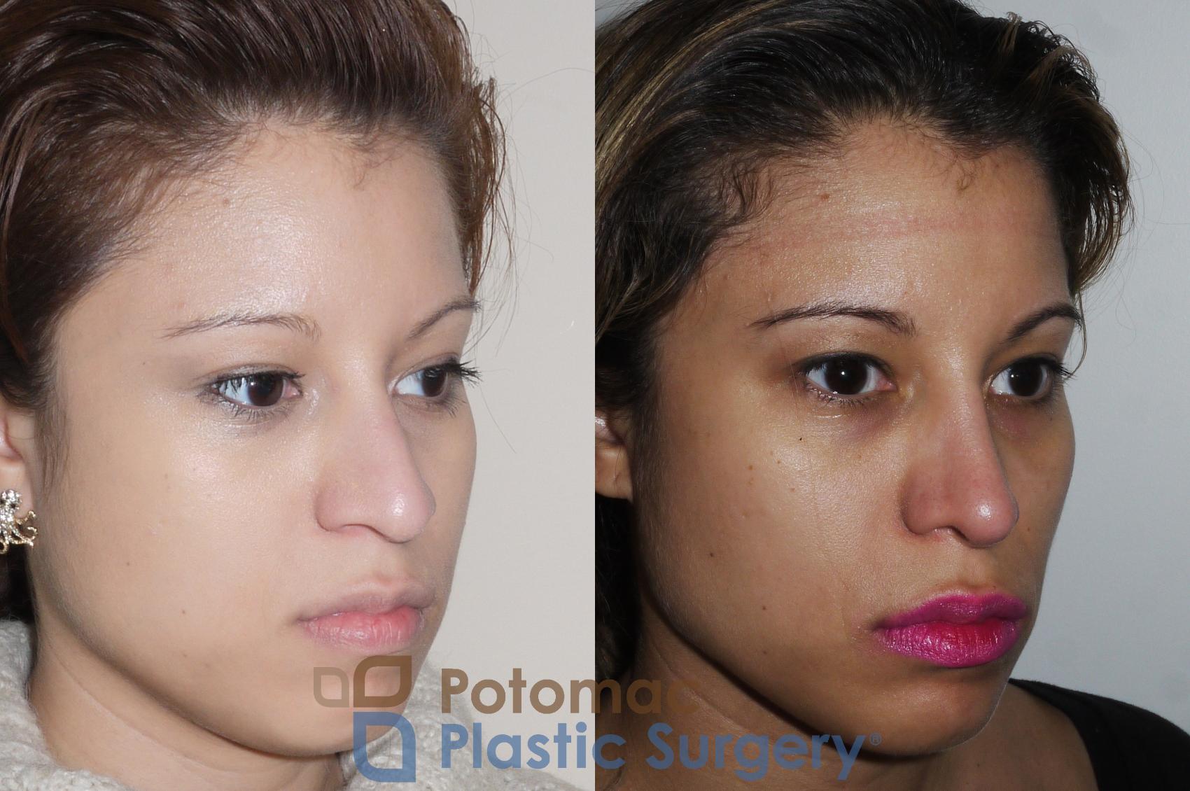 Before & After Rhinoplasty - Cosmetic Case 351 Right Oblique View in Washington DC & Arlington , DC