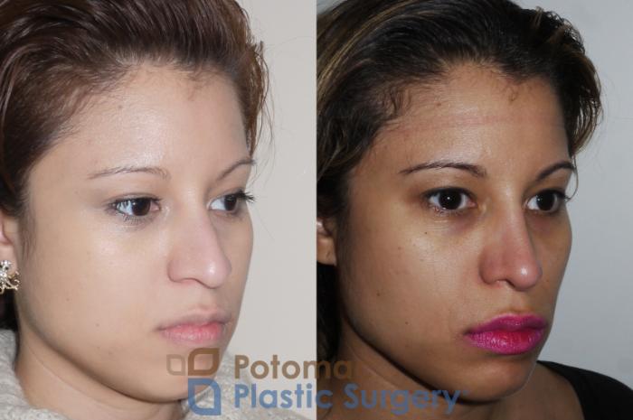 Before & After Rhinoplasty - Cosmetic Case 351 Right Oblique View in Washington DC & Arlington , DC