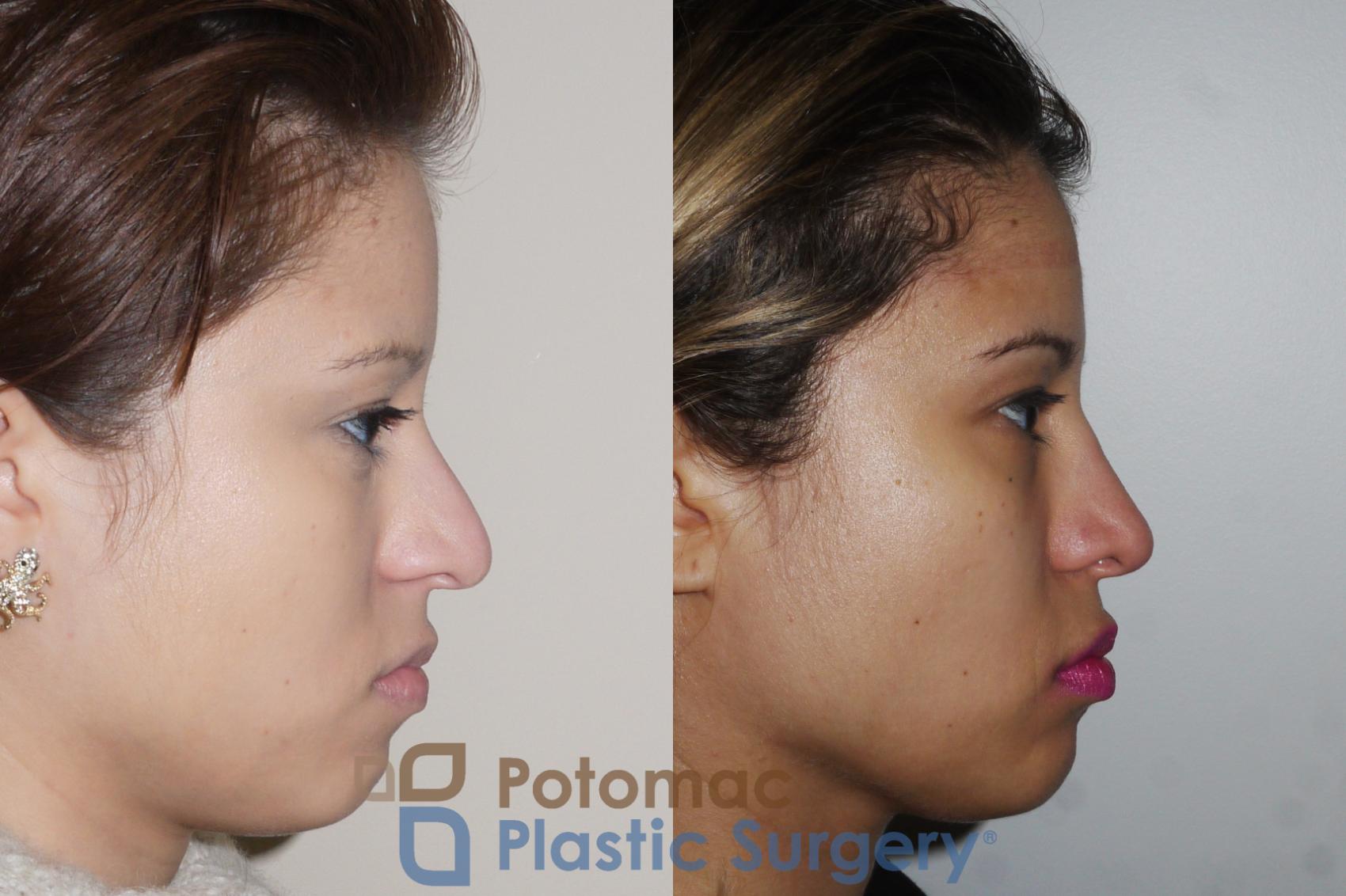 Before & After Rhinoplasty - Cosmetic Case 351 Right Side View in Washington DC & Arlington , DC