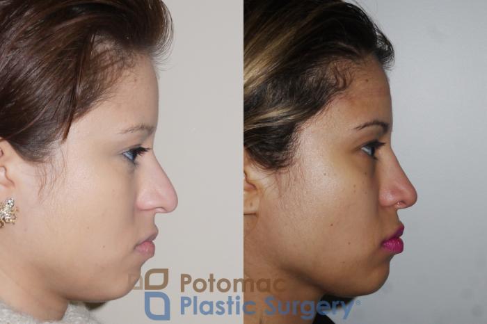 Before & After Rhinoplasty - Cosmetic Case 351 Right Side View in Washington DC & Arlington , DC