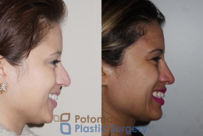 Before & After Rhinoplasty - Cosmetic Case 351 Right - Smiling View in Washington DC & Arlington , DC