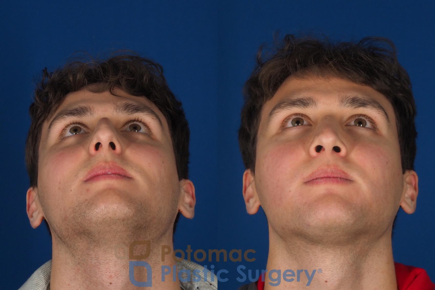 Before & After Rhinoplasty - Medical Case 352 Bottom View in Washington DC & Arlington , DC