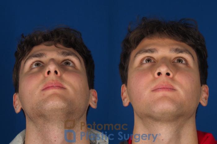 Before & After Rhinoplasty - Cosmetic Case 352 Bottom View in Washington DC & Arlington , DC