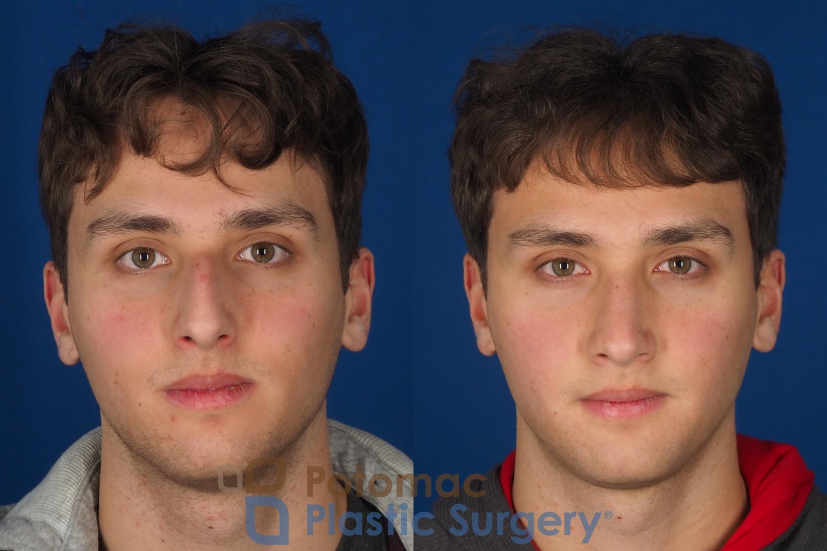 Before & After Rhinoplasty - Medical Case 352 Front View in Washington DC & Arlington , DC