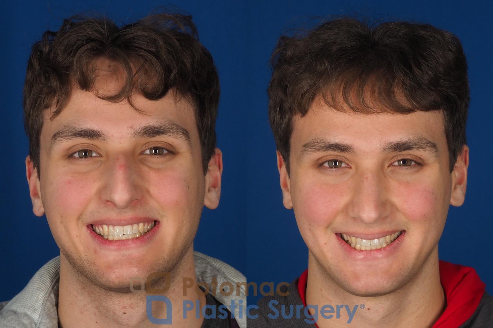 Before & After Rhinoplasty - Medical Case 352 Front - Smiling View in Washington DC & Arlington , DC