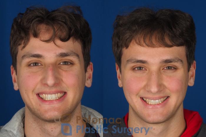 Before & After Rhinoplasty - Cosmetic Case 352 Front - Smiling View in Washington DC & Arlington , DC