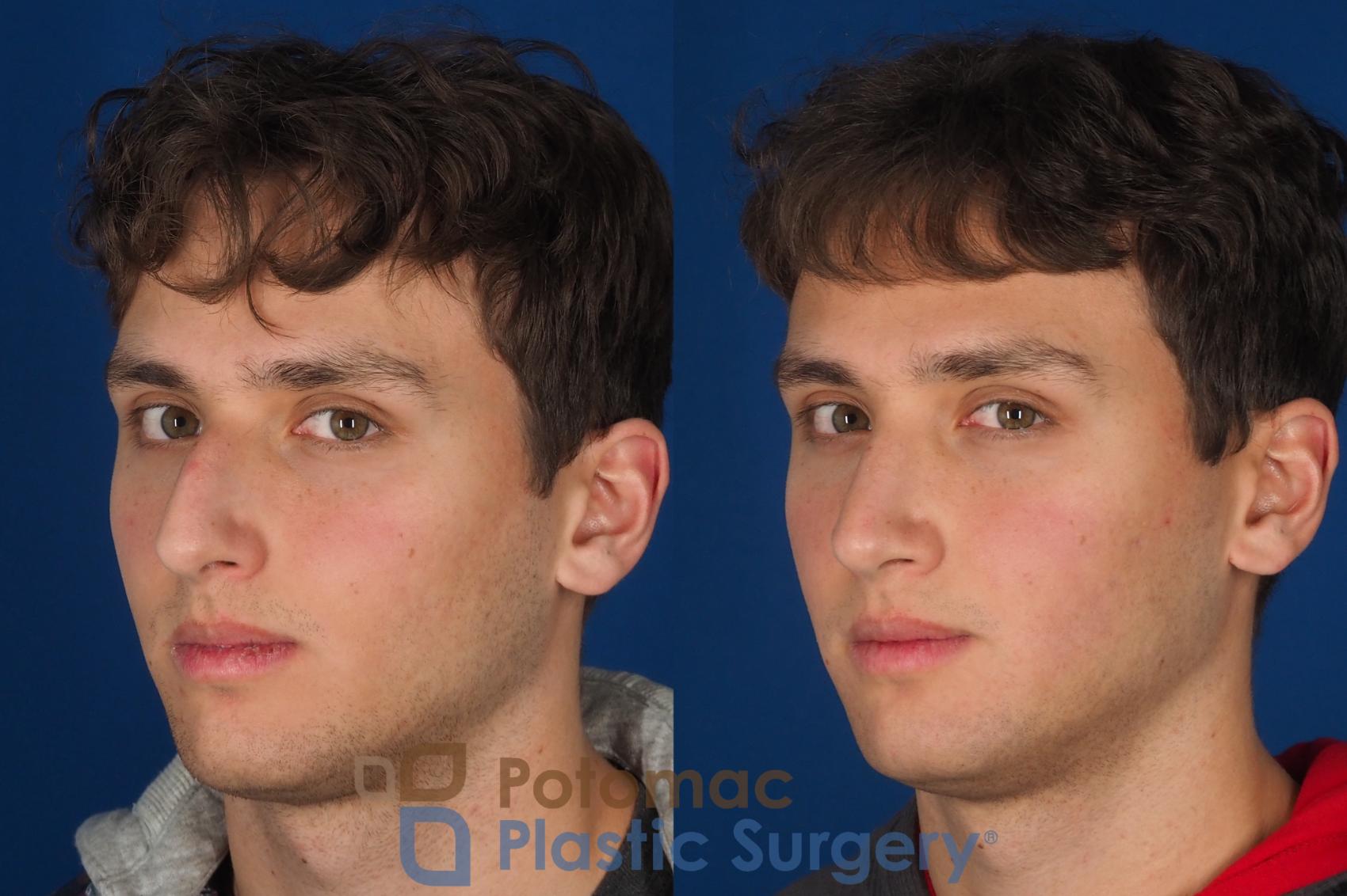 Before & After Rhinoplasty - Medical Case 352 Left Oblique 2 View in Washington DC & Arlington , DC