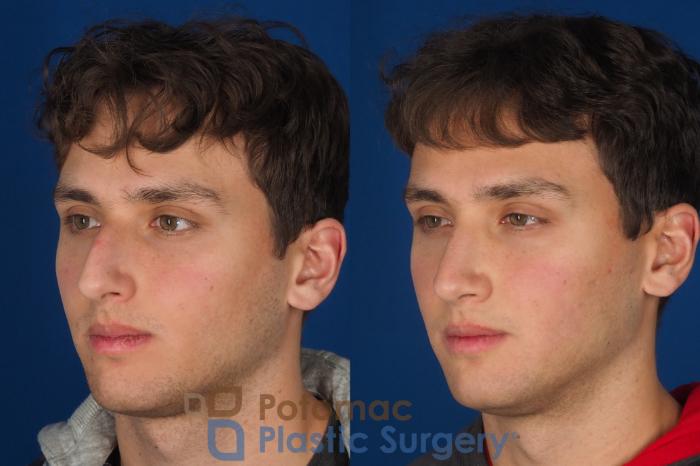 Before & After Rhinoplasty - Cosmetic Case 352 Left Oblique View in Washington DC & Arlington , DC