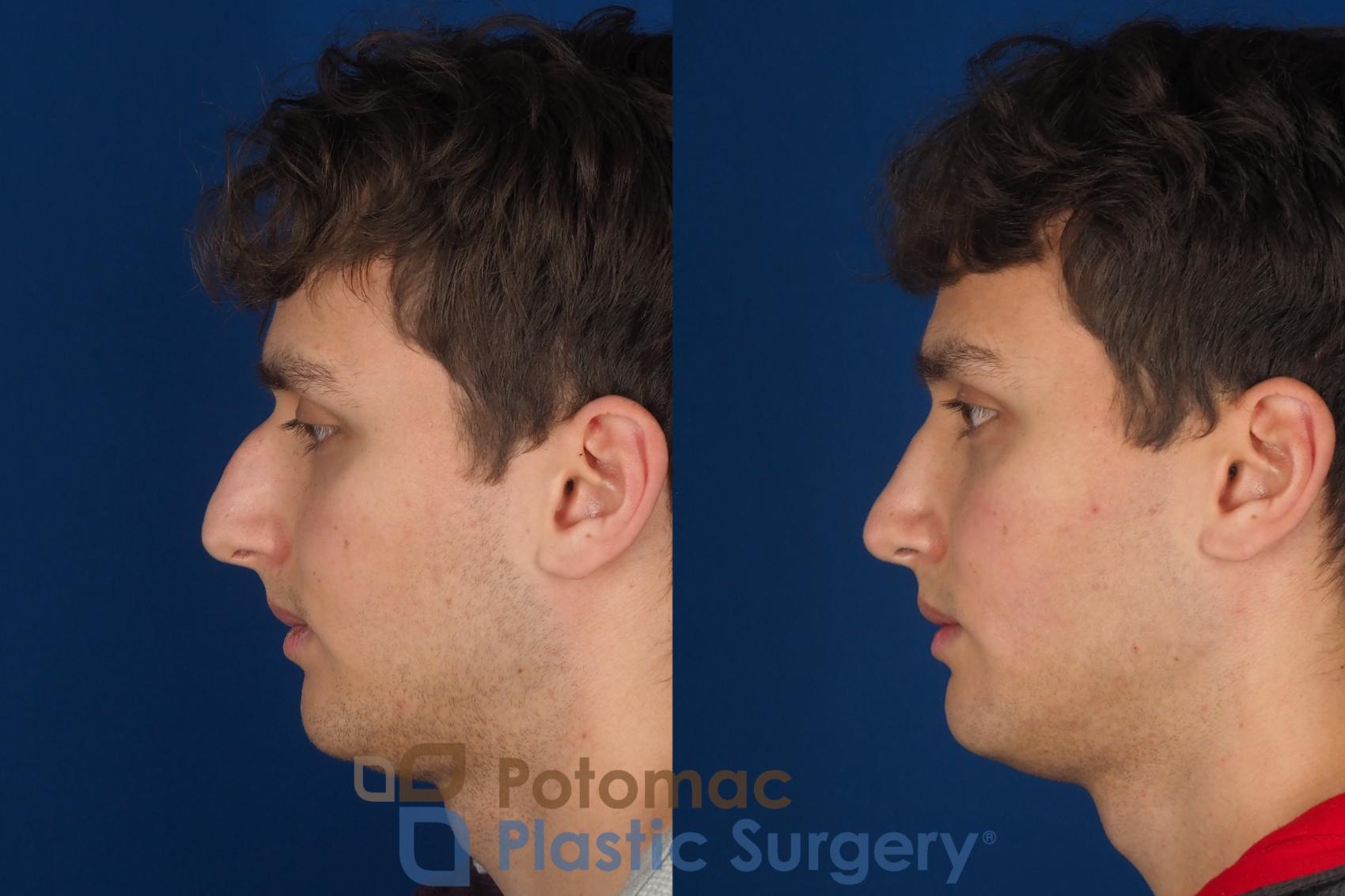 Before & After Rhinoplasty - Medical Case 352 Left Side View in Washington DC & Arlington , DC