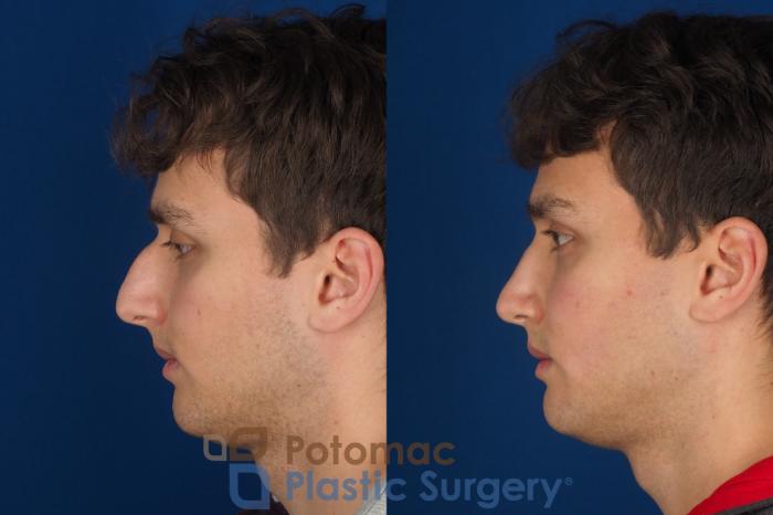 Before & After Rhinoplasty - Cosmetic Case 352 Left Side View in Washington DC & Arlington , DC