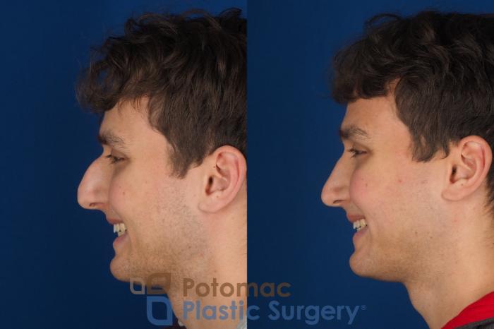 Before & After Rhinoplasty - Cosmetic Case 352 Left - Smiling View in Washington DC & Arlington , DC