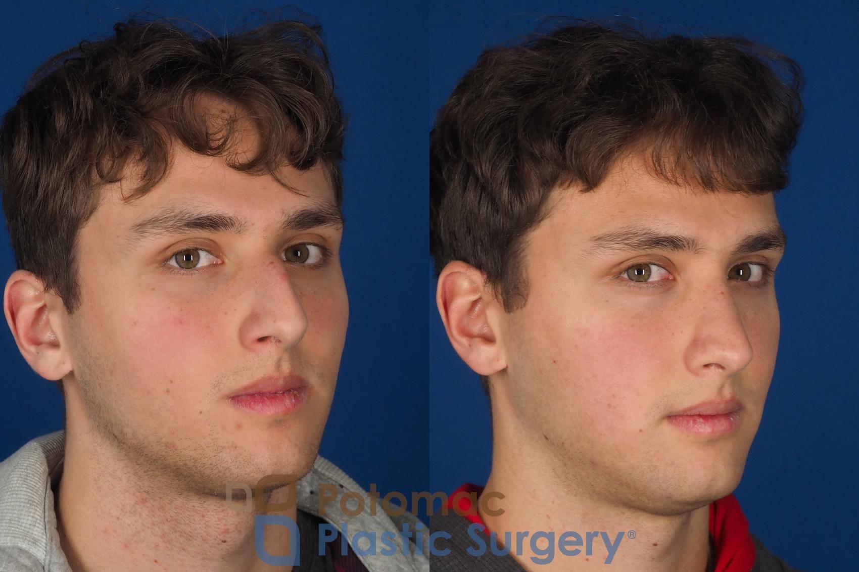 Before & After Rhinoplasty - Medical Case 352 Right Oblique 2 View in Washington DC & Arlington , DC