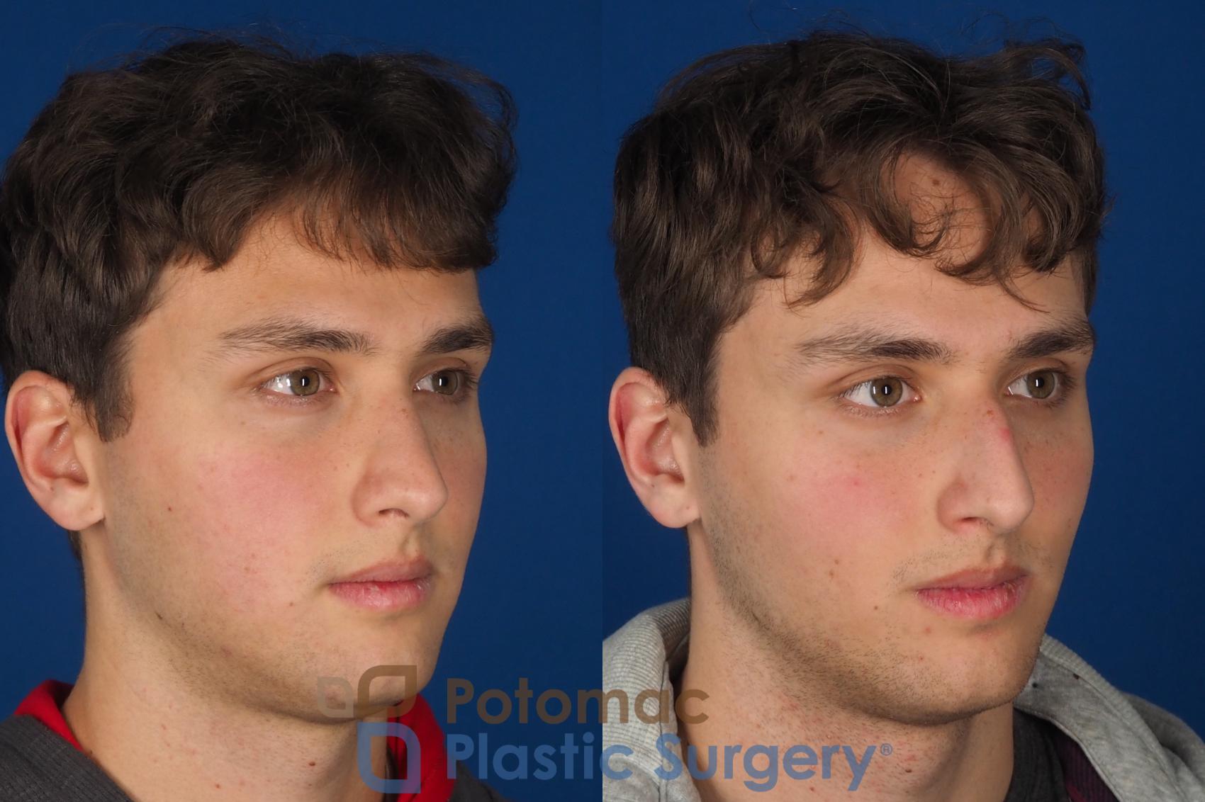 Before & After Rhinoplasty - Medical Case 352 Right Oblique View in Washington DC & Arlington , DC