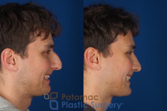 Before & After Rhinoplasty - Cosmetic Case 352 Right - Smiling View in Washington DC & Arlington , DC